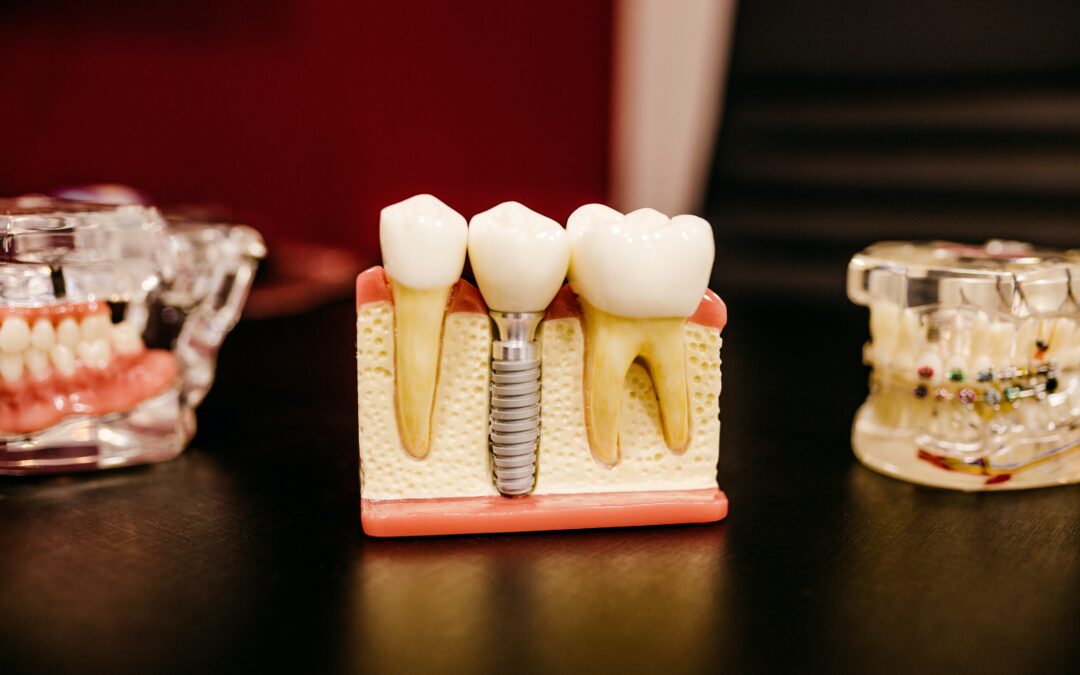 At What Age is Optimal for Dental Implant?